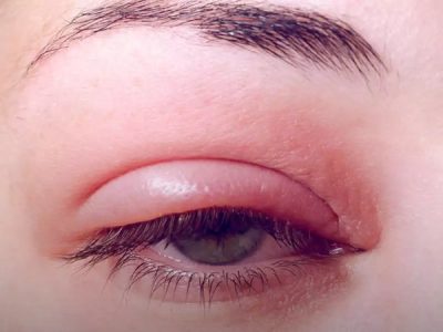 عوارض کاشت مژه هیدن