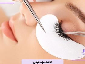 کاشت مژه هیدن