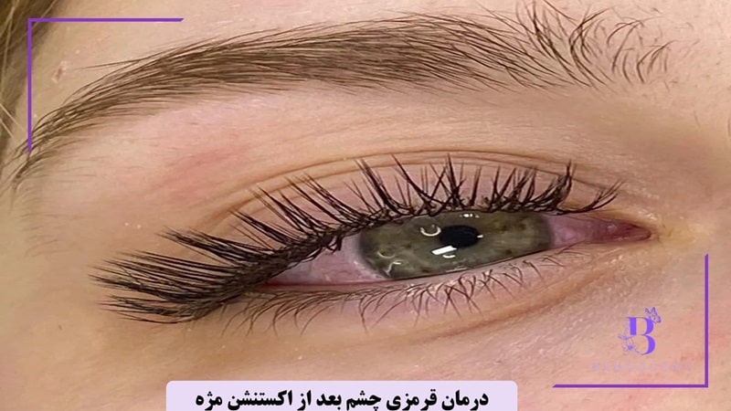 درمان قرمزی چشم بعد از اکستنشن مژه