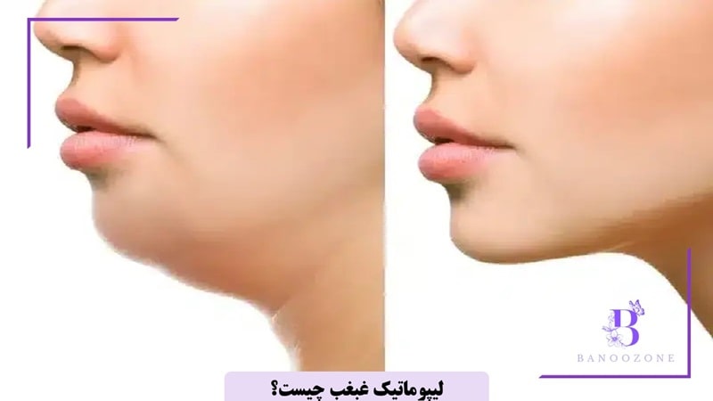 لیپوماتیک غبغب چیست؟