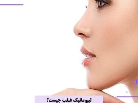 لیپوماتیک غبغب چگونه انجام میشود