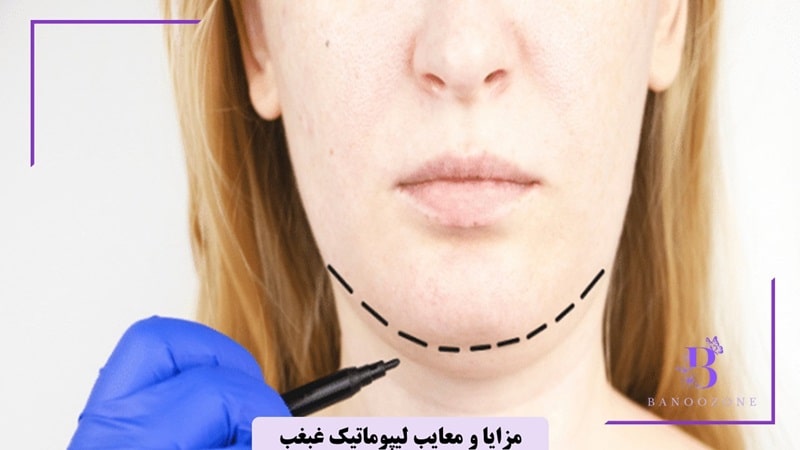 مزایا و معایب لیپوماتیک غبغب