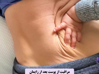 مراقبت از پوست بعد از زایمان