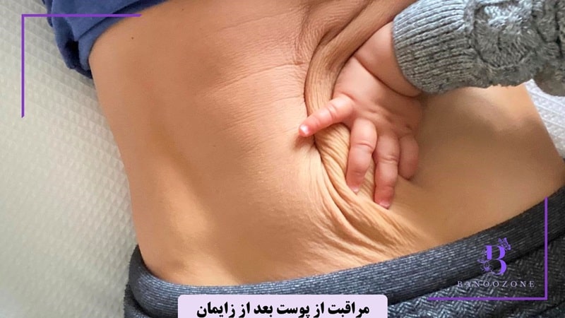 مراقبت از پوست بعد از زایمان