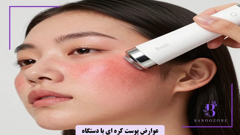 عوارض پوست کره ای با دستگاه